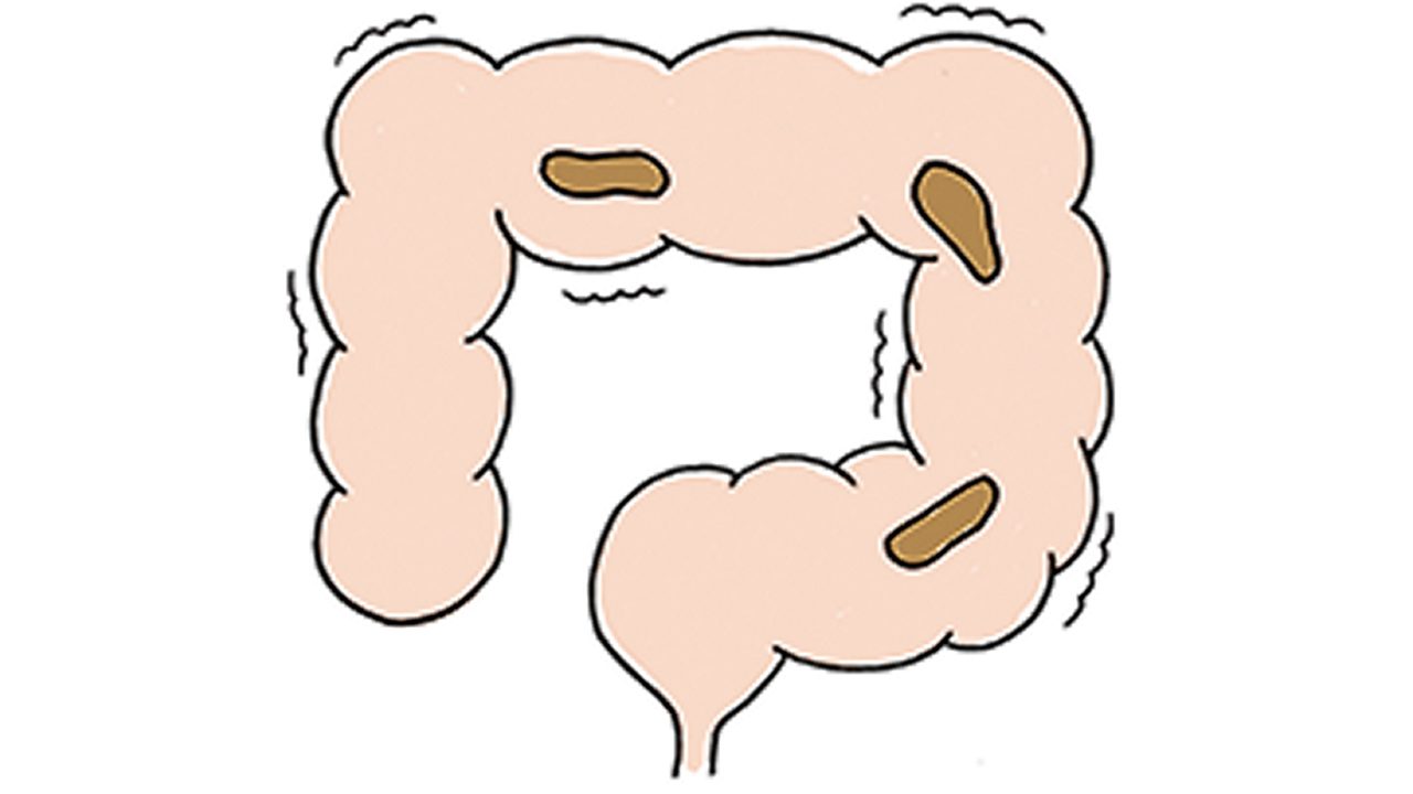 便を運ぶ大腸の働きが弱まっている