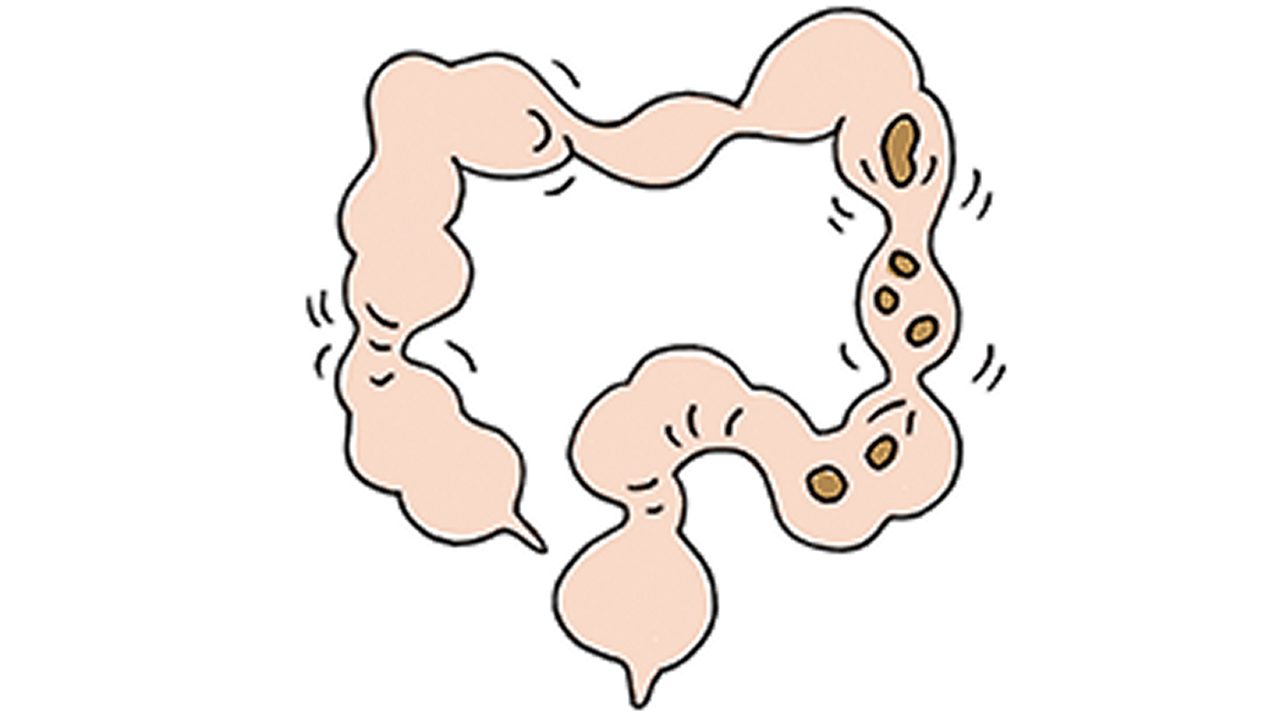 病気で腸管が狭くなっている
