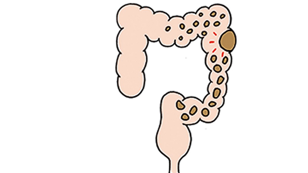病気で腸の一部に異常が起きている