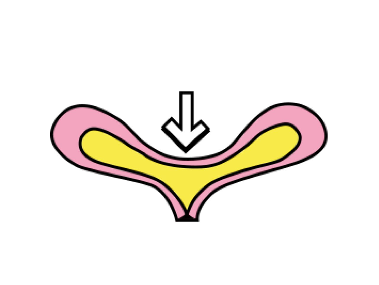 overactive bladder, bladder contracting