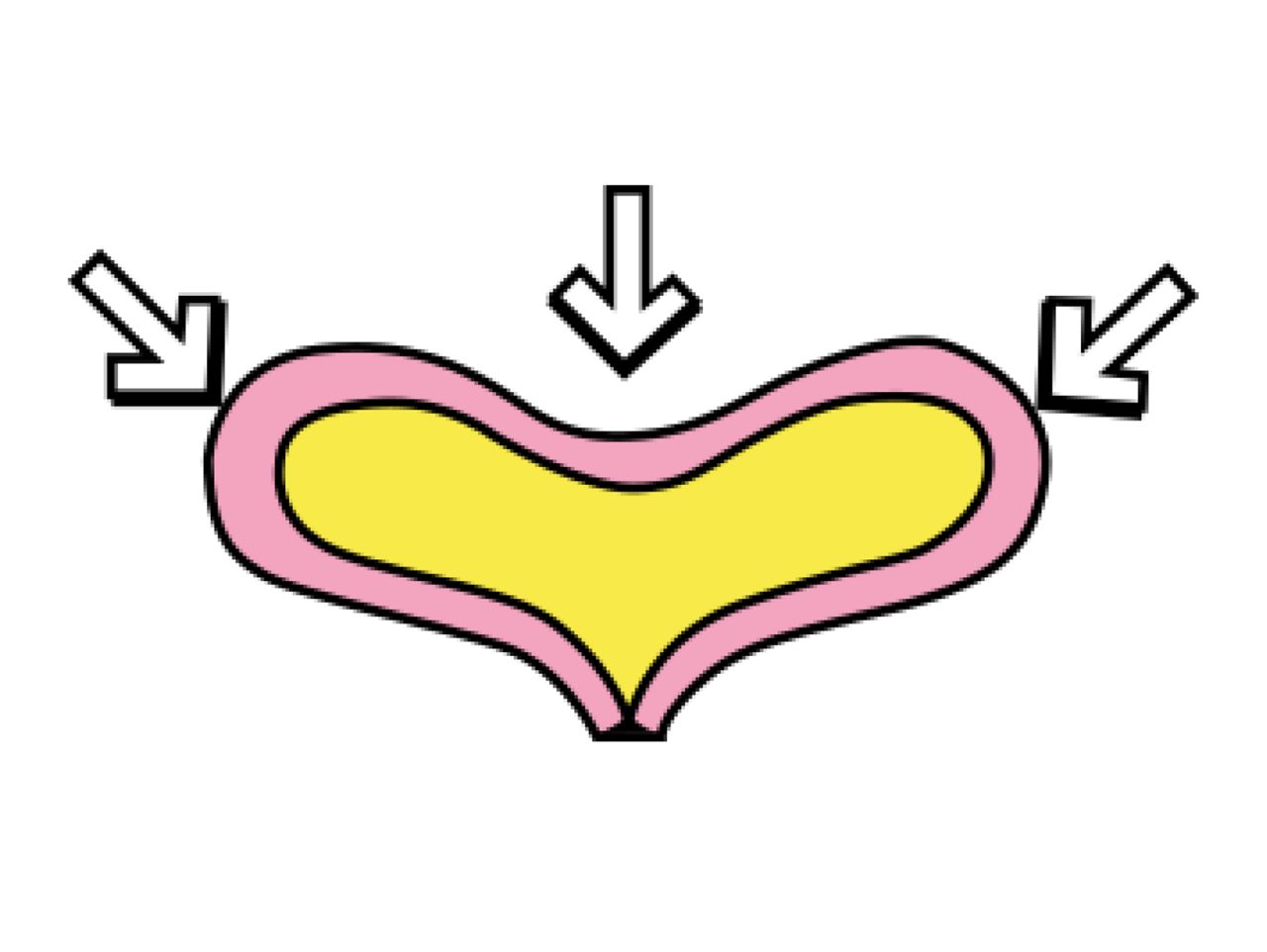 overactive bladder, bladder compression